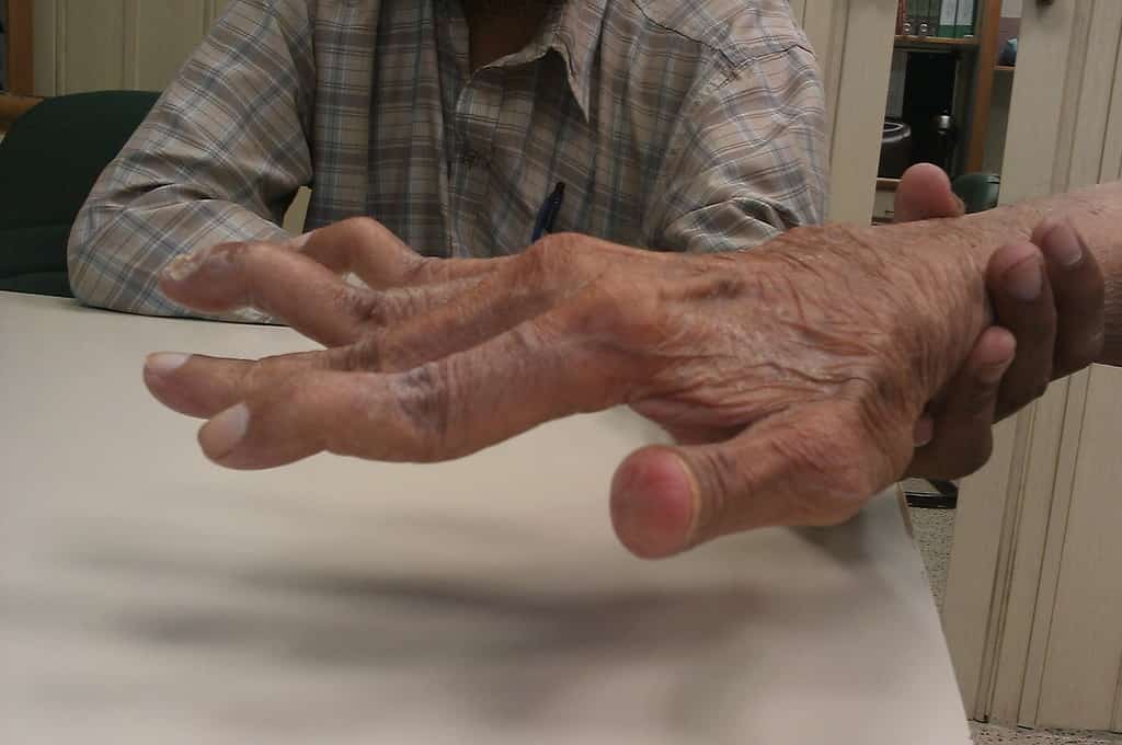 É possível se aposentar com Artrite Reumatoide?