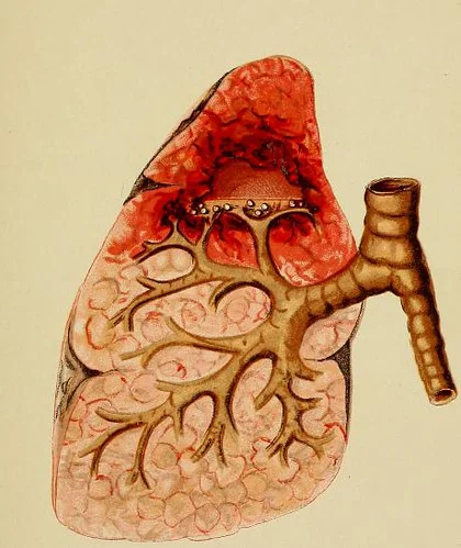 This image is taken from A handbook of physical diagnosis of diseases of the organs of respiration and heart, and of aortic aneurism